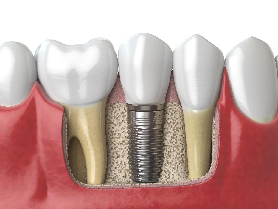 3D rendering of dental implant in jaw | dental implants white bear lake mn