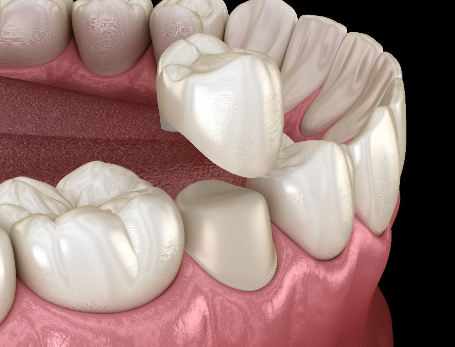 close up of dental crown | dental crown white bear lake mn