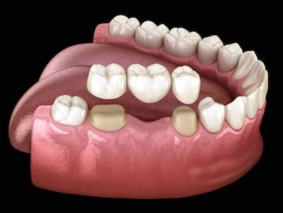 close up of dental crown in jaw | white bear dentist
