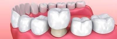 close up of CEREC dental crown l family dentist near me