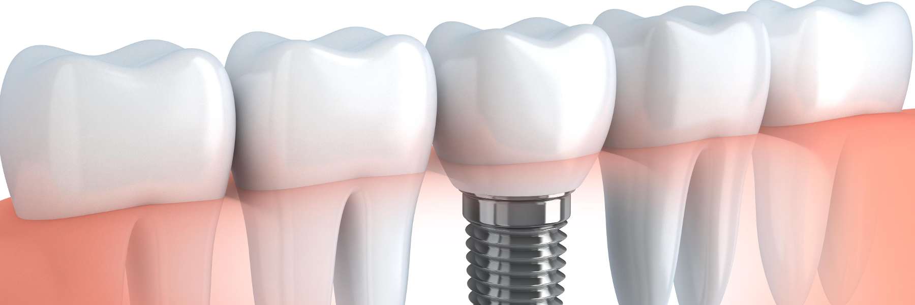 close up of dental implant in jaw | white bear lake dentist