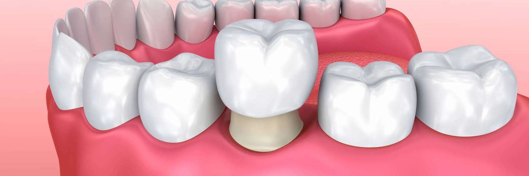 Diagram of a CEREC dental crown on a tooth in White Bear Lake MN