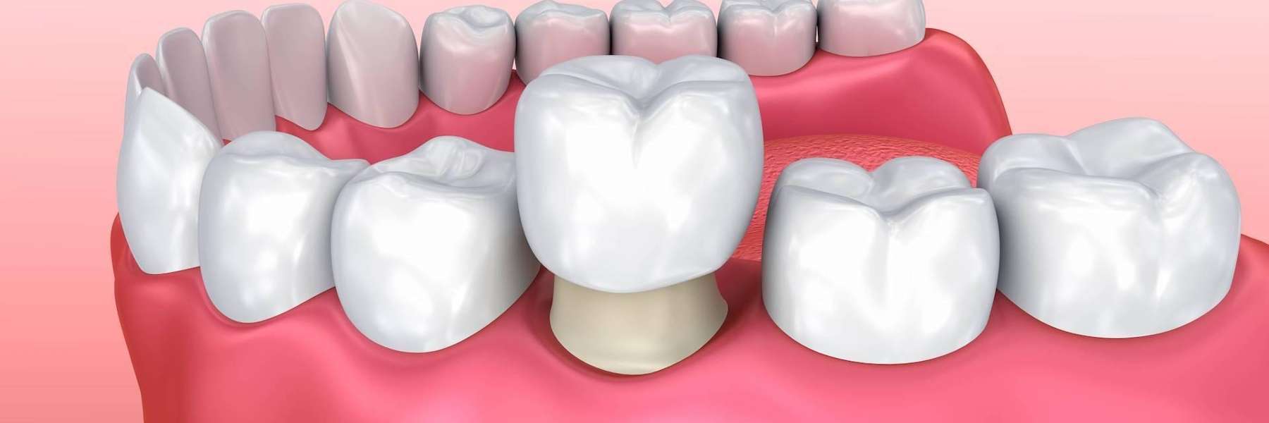 3D rendering of dental crown | dentist white bear lake mn