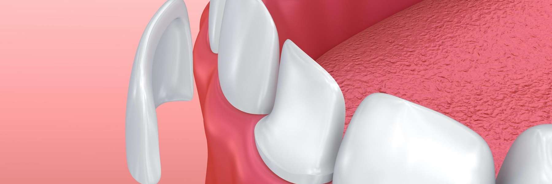close up of porcelain veneers | veneers white bear lake mn