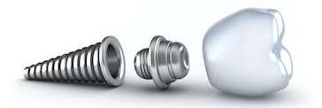 dental implant post image