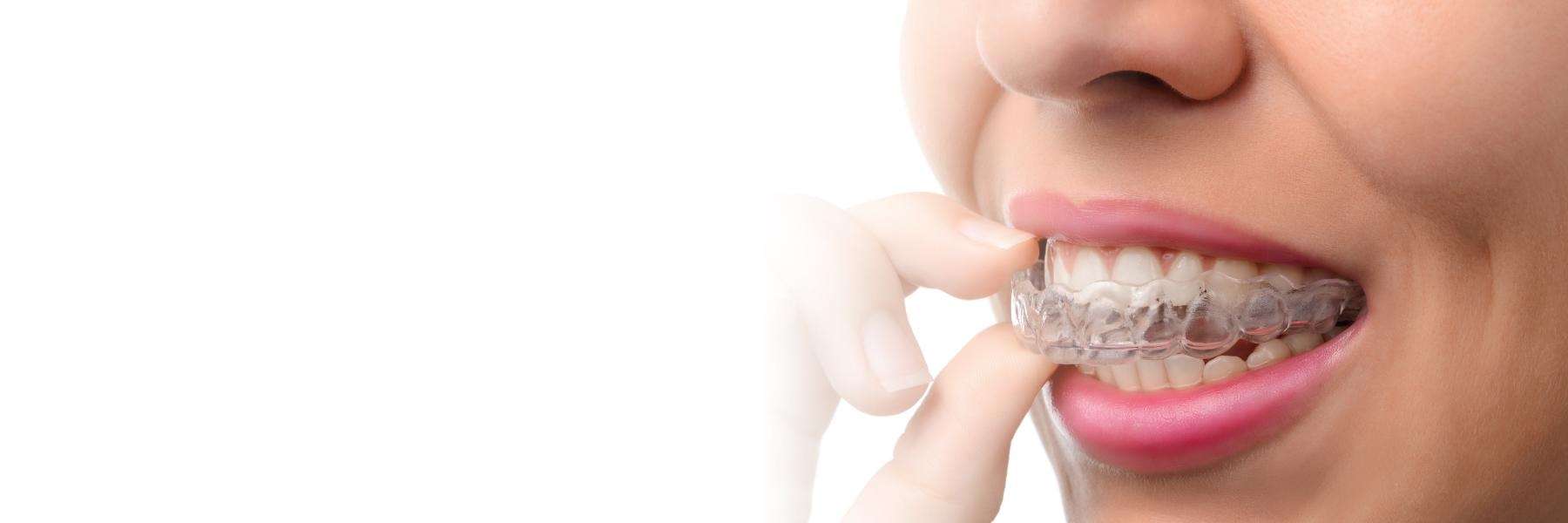 close up of clear plastic aligner | suresmile dentist