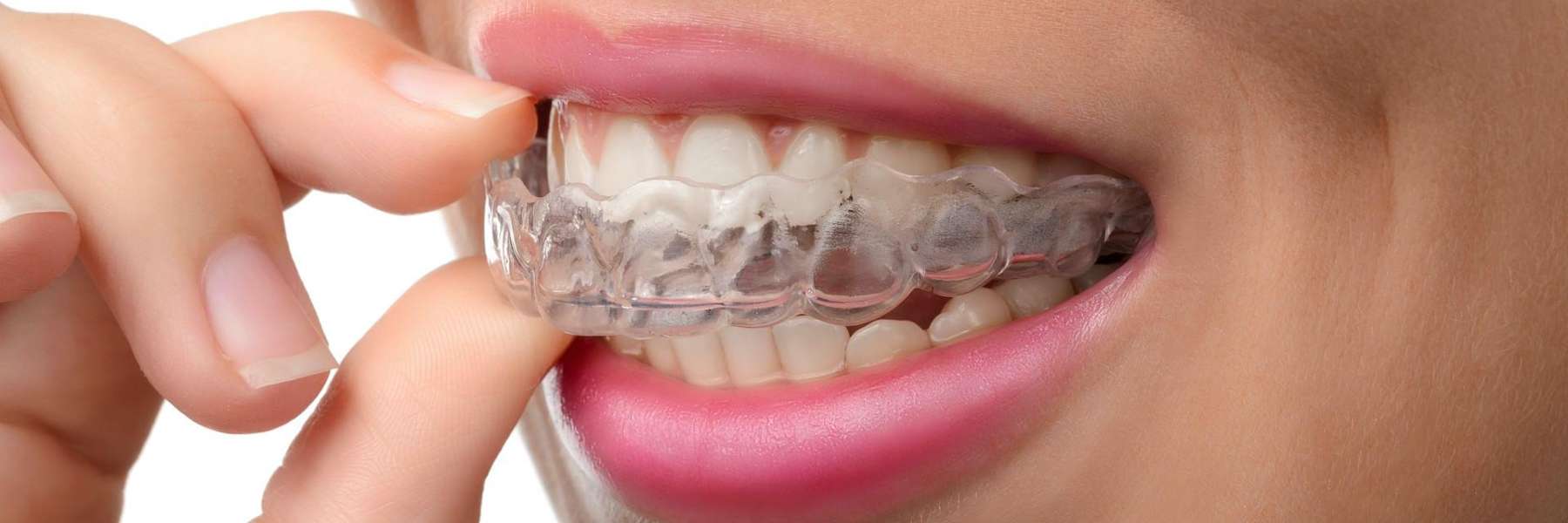Invisalign in White Bear Lake