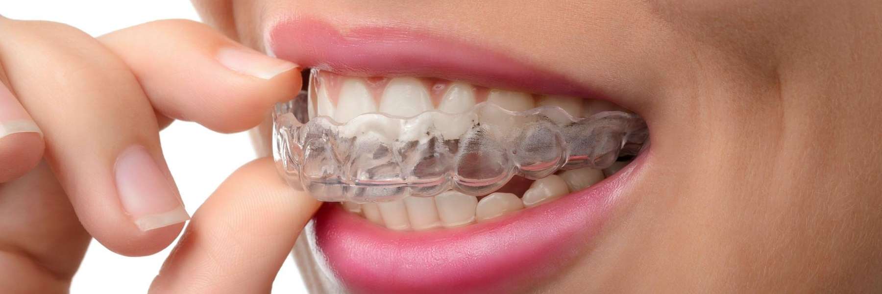 woman putting in clear aligner | white bear lake dentist