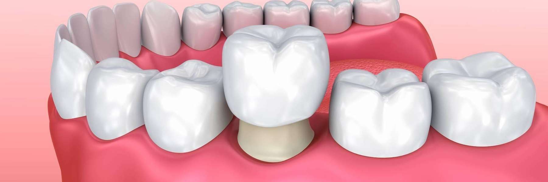 cerec dental crowns white bear lake mn