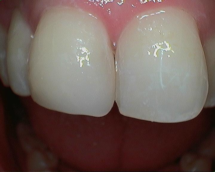 Repair-Chipped-Teeth-After-Image