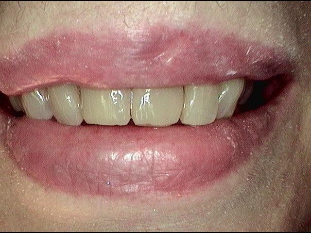 Contouring-and-a-Tooth-Colored-Fillings-After-Image
