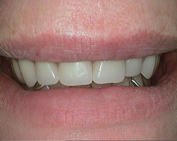 Dentures-and-Partials-Complete-Smile-After-Image