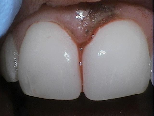 Emergency-Dentistry-After-Image
