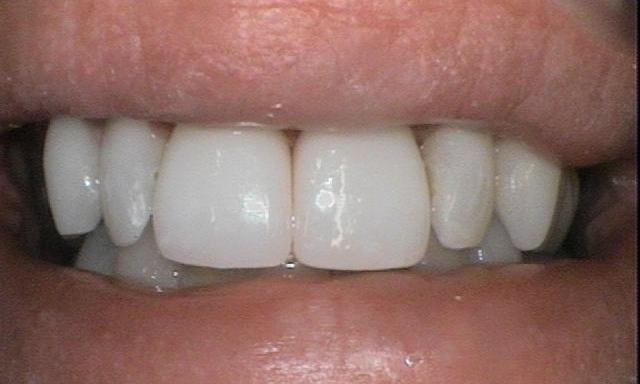 Boost-Whitening-and-Dental-Crowns-After-Image