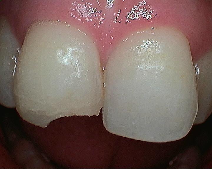 Repair-Chipped-Teeth-Before-Image