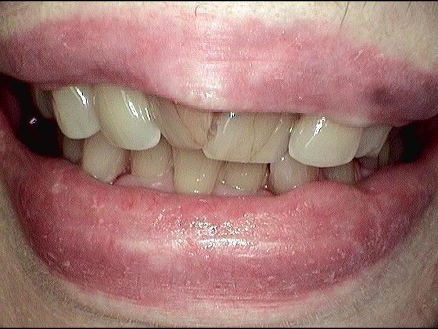 Contouring-and-a-Tooth-Colored-Fillings-Before-Image