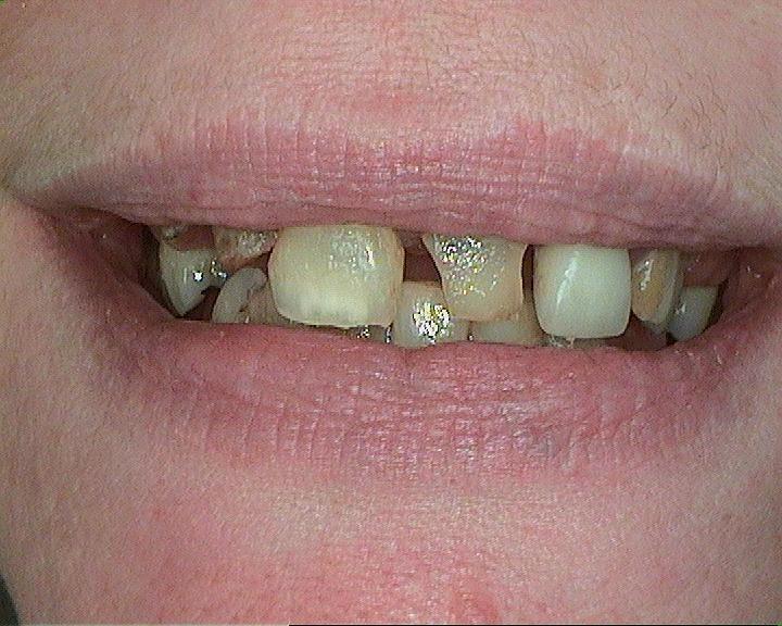 Dentures-and-Partials-Complete-Smile-Before-Image