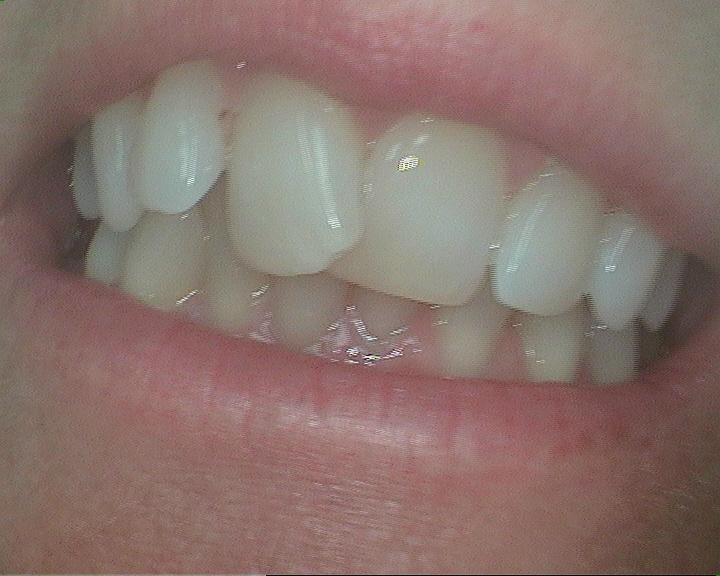 Economical-Smile-Make-over-Before-Image