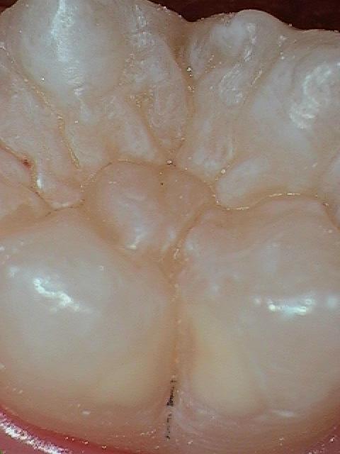 Sealants-Before-Image