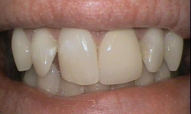 Boost-Whitening-and-Dental-Crowns-Before-Image
