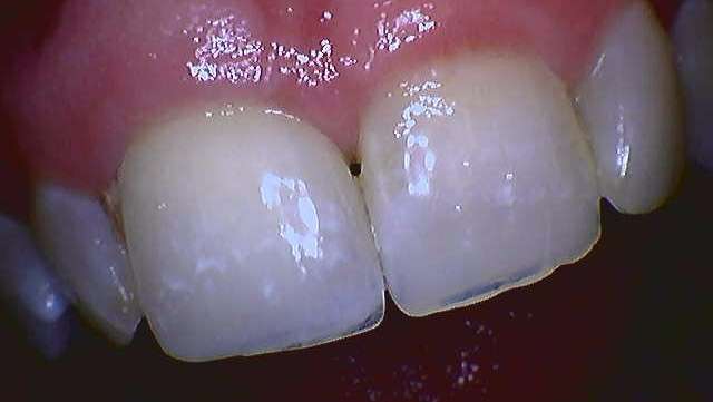 Implant-Crown-After-Image