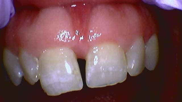 Implant-Crown-Before-Image
